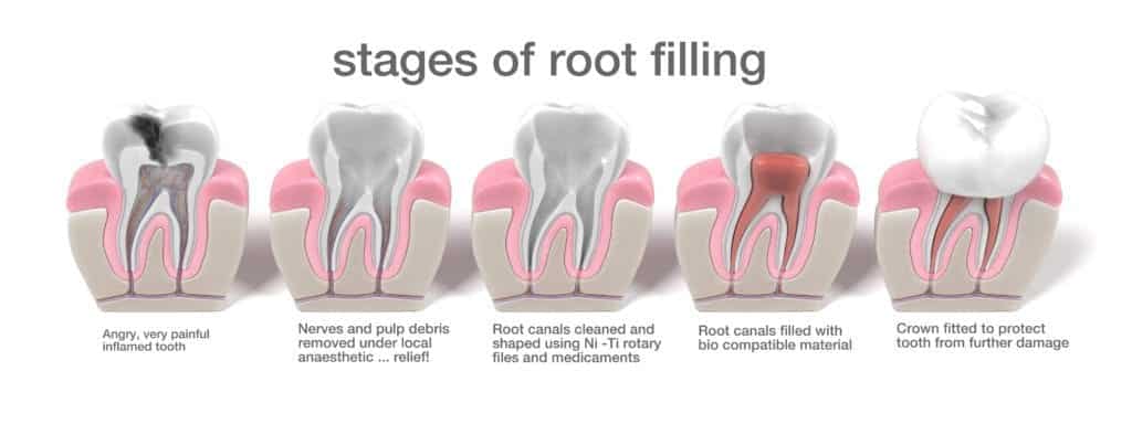 How Long Does A Root Canal Take Before The Filling Is Placed In The Canal?